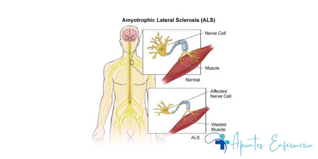 Plan de cuidados de enfermería y gestión de la esclerosis lateral amiotrófica (ELA)
