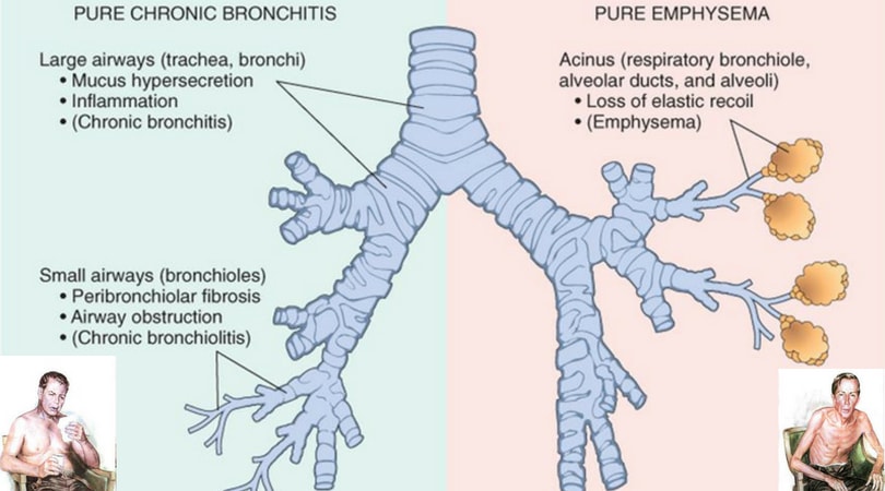 Bronquitis crónica frente a enfisema