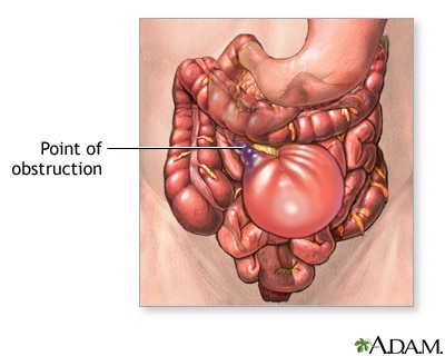 Reparación de la obstrucción intestinal
