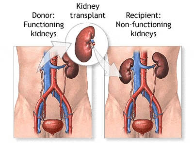 Trasplante de riñón