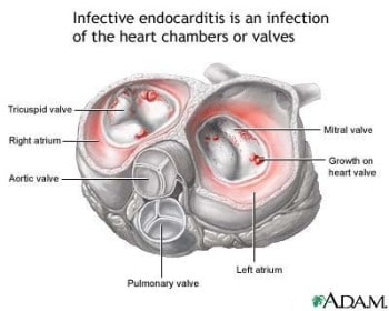 Manejo de enfermería de la endocarditis