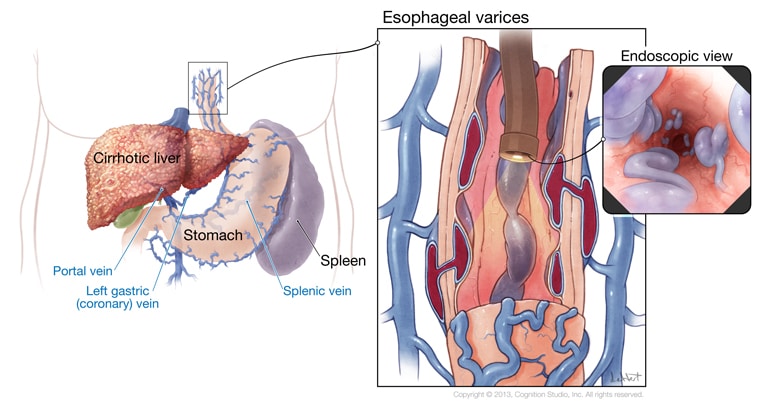 Gestión de enfermería de las várices esofágicas