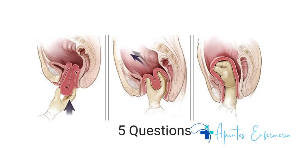 Examen práctico de inversión uterina